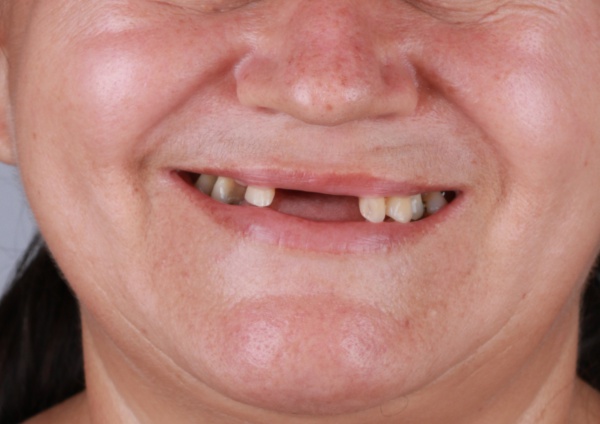 Edilma paciente antes implantes dentários rk odontologia