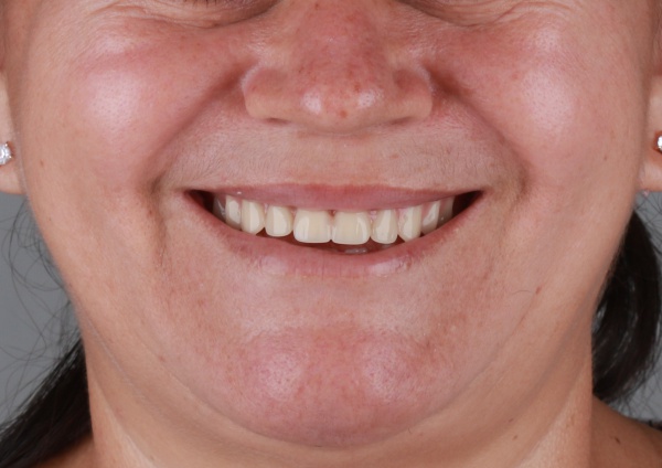 Edilma paciente implantes dentários rk odontologia
