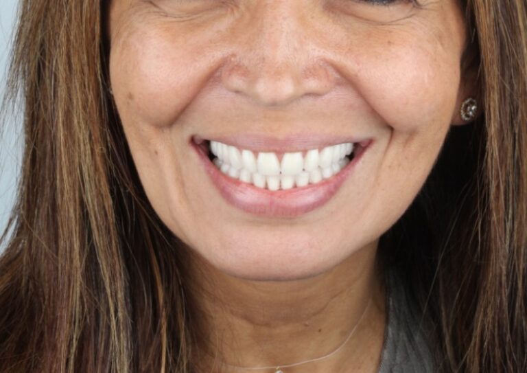 Jailda Antes paciente implantes dentários rk odontologia